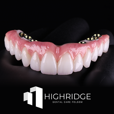 Hybrid Implant Bridge