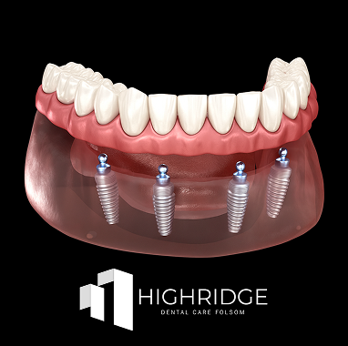 Zirconia Implant Bridge