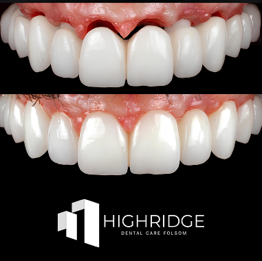 Porcelain Implant Bridge